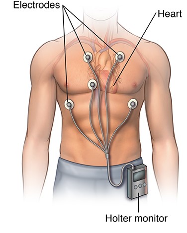 Holter Monitor Screening | Reflex Medical Centre Mississauga